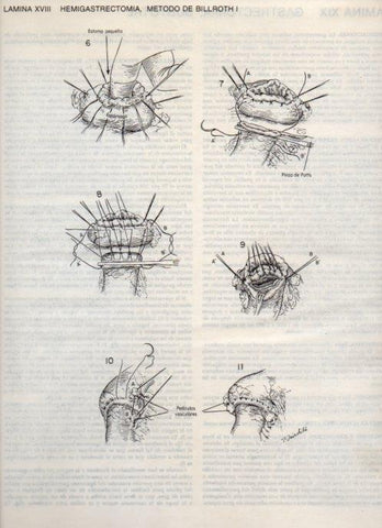 LAMINA V20079: Hemigastrectomia, metodo de Billroth I
