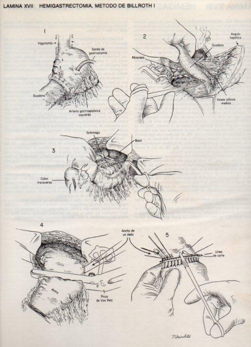 LAMINA V20078: Hemigastrectomia, metodo de Billroth I