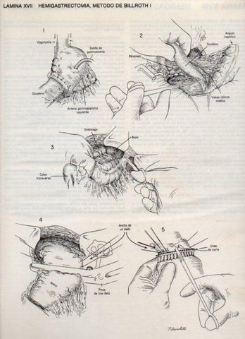 LAMINA V20078: Hemigastrectomia, metodo de Billroth I