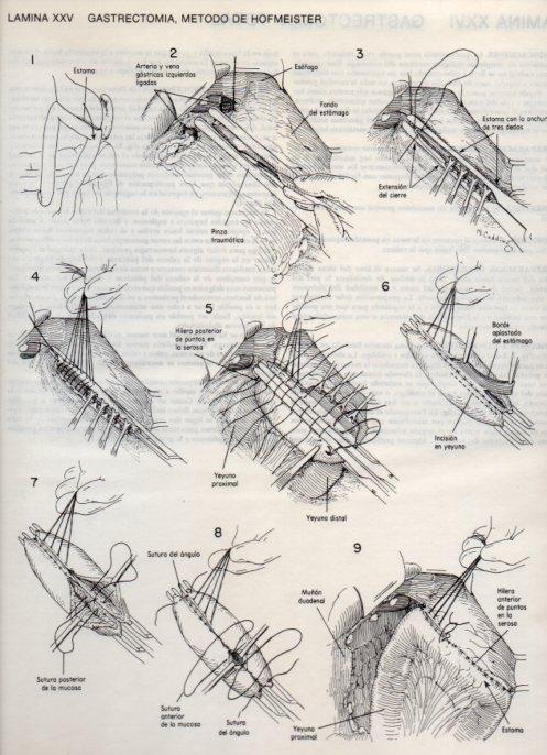 LAMINA V20086: Gastrectomia, metodo de Hofmeister