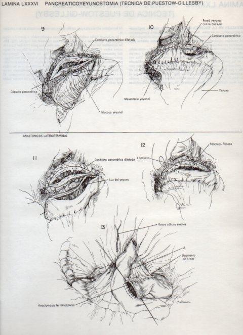 LAMINA V20146: Pancreaticoyeyunostomia, tecnica de Puestow-Gillesby 2