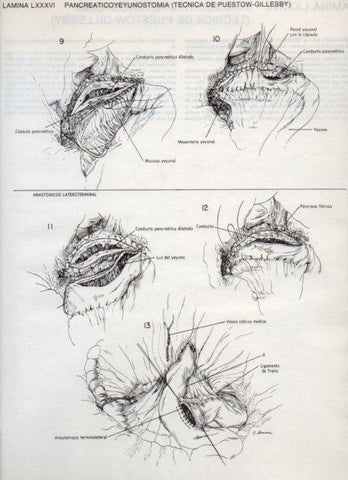 LAMINA V20146: Pancreaticoyeyunostomia, tecnica de Puestow-Gillesby 2