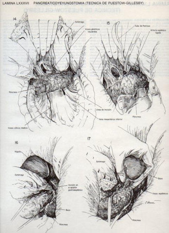 LAMINA V20147: Pancreaticoyeyunostomia, tecnica de Puestow-Gillesby 3