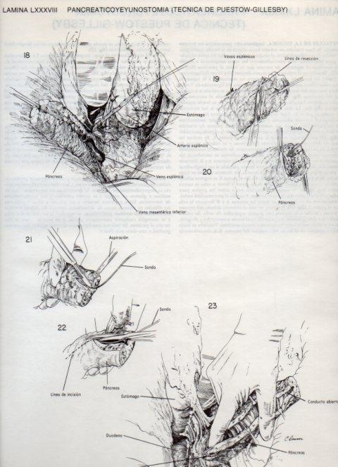 LAMINA V20148: Pancreaticoyeyunostomia, tecnica de Puestow-Gillesby 4