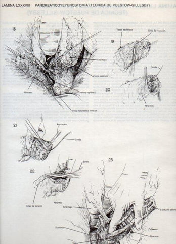 LAMINA V20148: Pancreaticoyeyunostomia, tecnica de Puestow-Gillesby 4