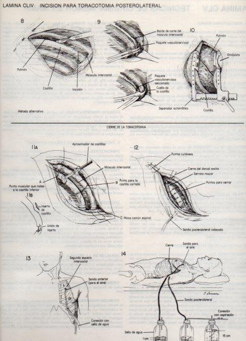 LAMINA V20215: Incision para toracotomia posterolateral