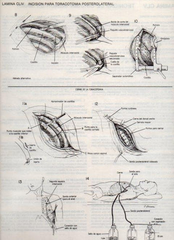 LAMINA V20215: Incision para toracotomia posterolateral