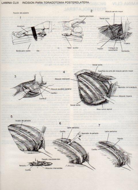 LAMINA V20214: Incision para toracotomia posterolatera