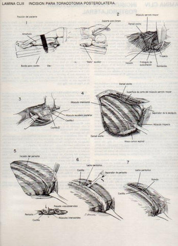 LAMINA V20214: Incision para toracotomia posterolatera
