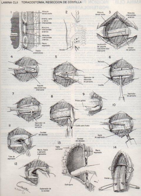 LAMINA V20213: Toracostomia, reseccion de costilla