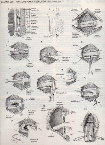 LAMINA V20213: Toracostomia, reseccion de costilla