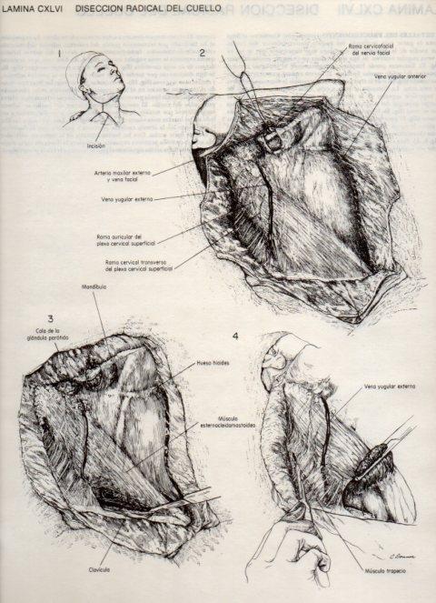 LAMINA V20207: Diseccion radical del cuello