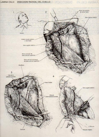 LAMINA V20207: Diseccion radical del cuello