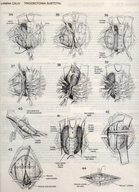 LAMINA V20205: Tiroidectomia subtotal 3