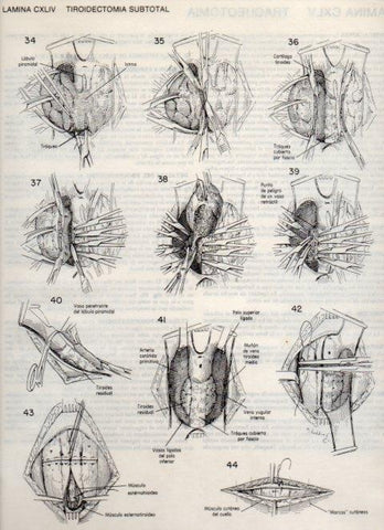 LAMINA V20205: Tiroidectomia subtotal 3