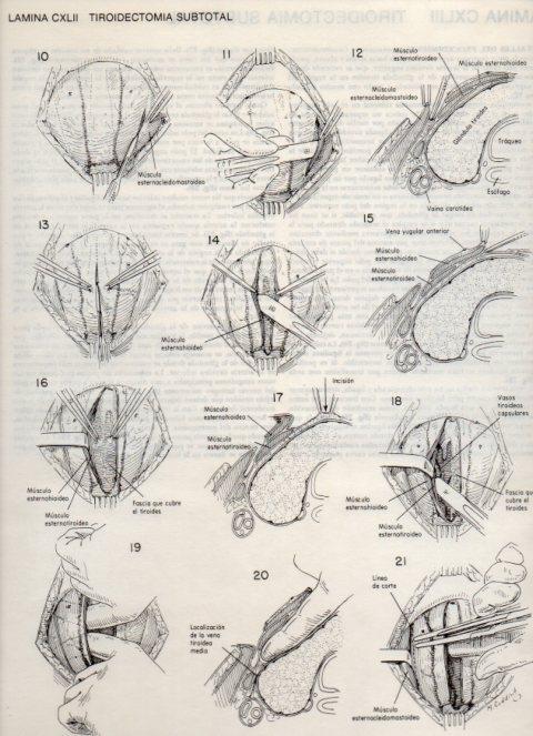 LAMINA V20203: Tiroidectomia subtotal 1