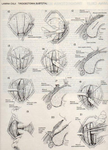 LAMINA V20203: Tiroidectomia subtotal 1