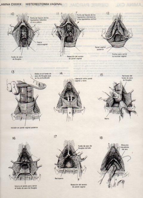 LAMINA V20200: Histerectomia vaginal