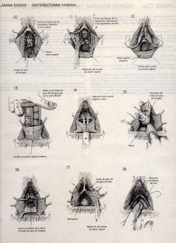 LAMINA V20200: Histerectomia vaginal
