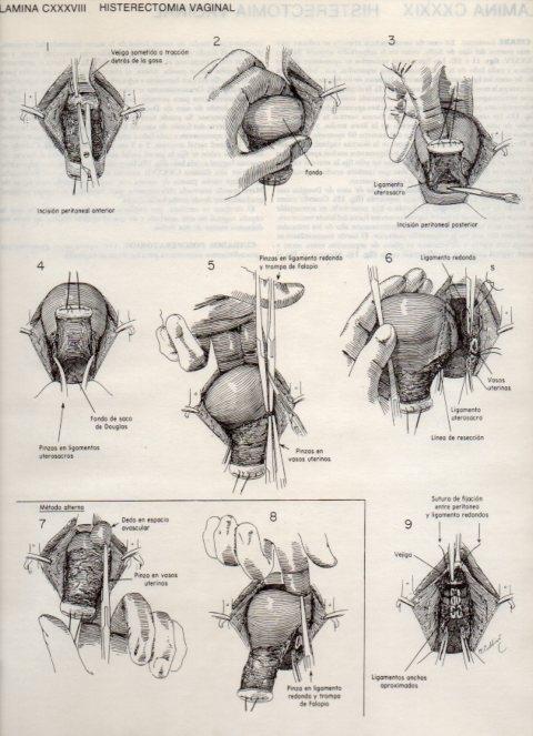 LAMINA V20199: Histerectomia vaginal
