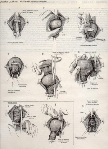 LAMINA V20199: Histerectomia vaginal