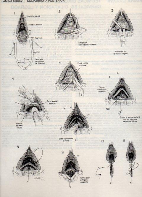 LAMINA V20197: Colporrafia posterior
