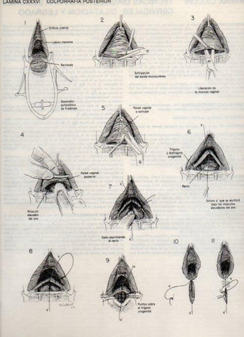 LAMINA V20197: Colporrafia posterior