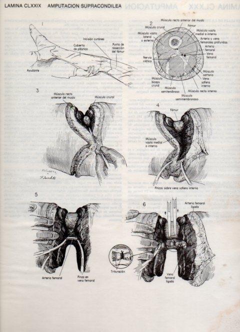 LAMINA V20240: Amputacion supracondilea