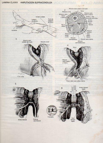 LAMINA V20240: Amputacion supracondilea