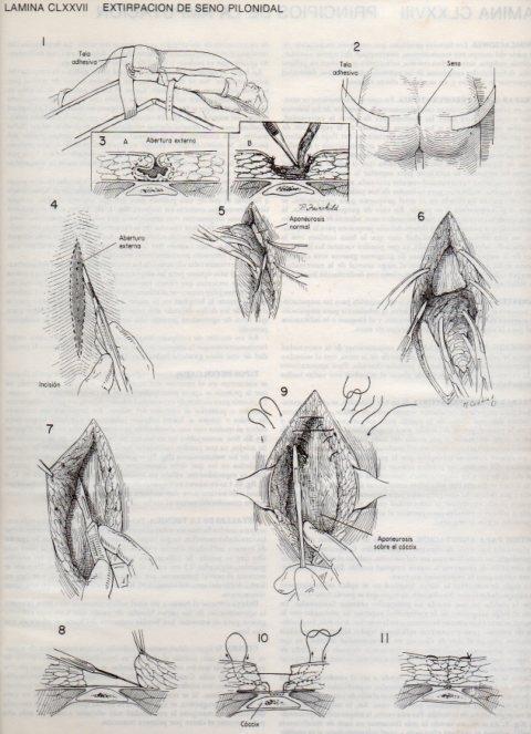 LAMINA V20238: Extirpacion de seno pilonidal