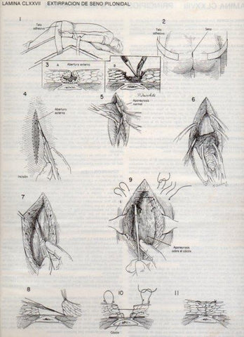 LAMINA V20238: Extirpacion de seno pilonidal