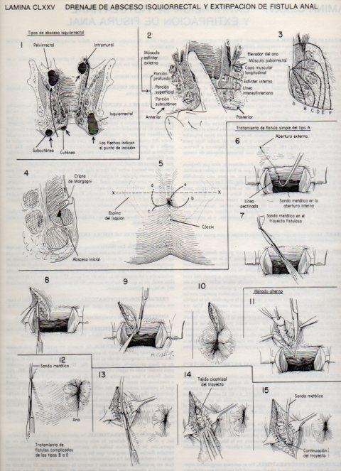 LAMINA V20236: Drenaje de absceso isquiorrectal y extirpacion de fistula anal