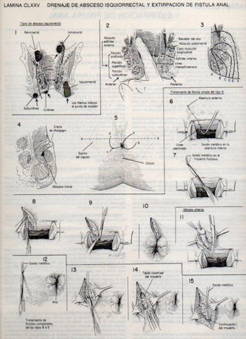 LAMINA V20236: Drenaje de absceso isquiorrectal y extirpacion de fistula anal