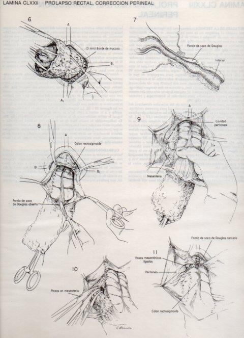 LAMINA V20233: Prolapso rectal, correccion perineal 1