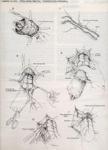 LAMINA V20233: Prolapso rectal, correccion perineal 1