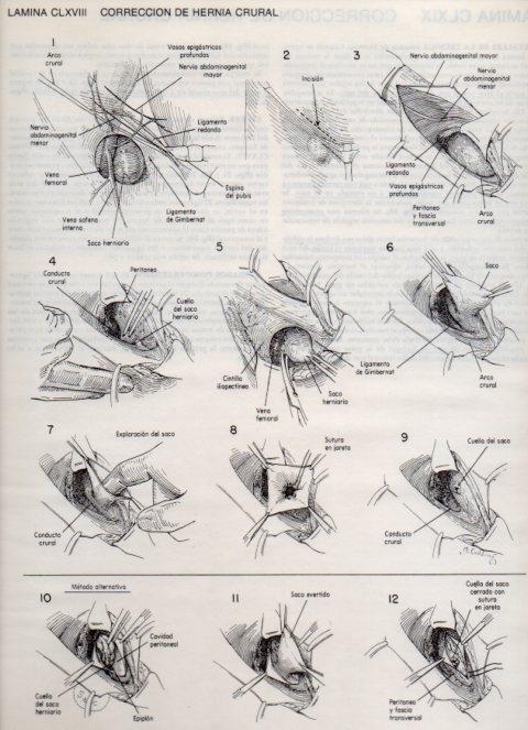 LAMINA V20229: Correccion de hernia crural
