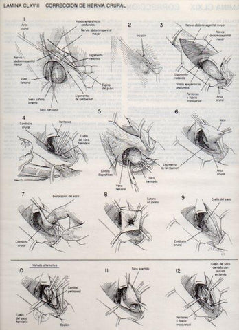LAMINA V20229: Correccion de hernia crural