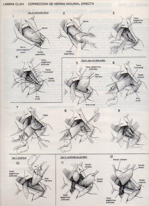 LAMINA V20227: Correccion de hernia inguinal indirecta 4