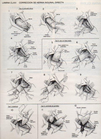 LAMINA V20227: Correccion de hernia inguinal indirecta 4