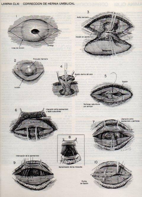 LAMINA V20222: Correccion de hernia umbilical