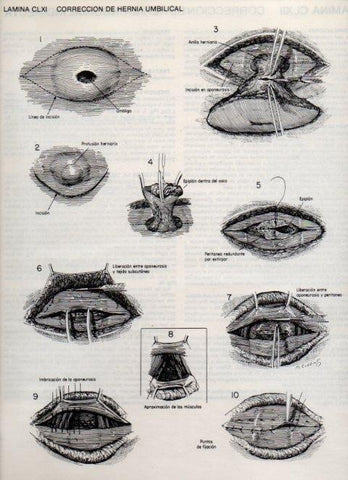 LAMINA V20222: Correccion de hernia umbilical