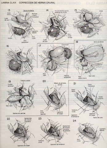 LAMINA V20230: Correccion de hernia crural 1