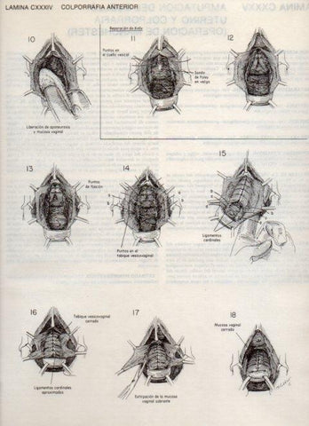 LAMINA V20195: Colporrafia anterior 1