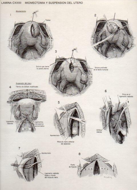 LAMINA V20193: Miomectomia y suspension del utero