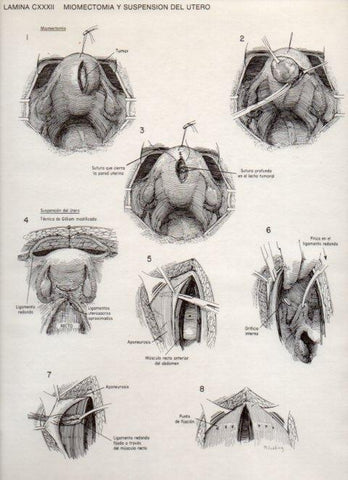LAMINA V20193: Miomectomia y suspension del utero