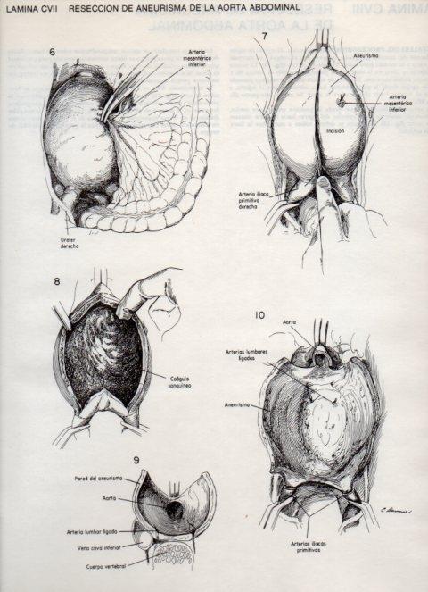 LAMINA V20168: Reseccion de aneurisma de la aorta abdominal