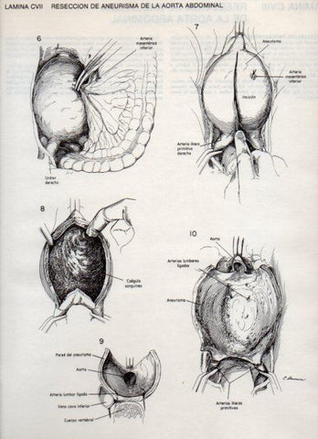 LAMINA V20168: Reseccion de aneurisma de la aorta abdominal