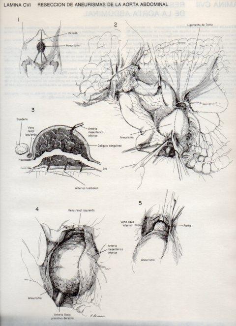 LAMINA V20167: Reseccion de aneurismas de la aorta abdominal