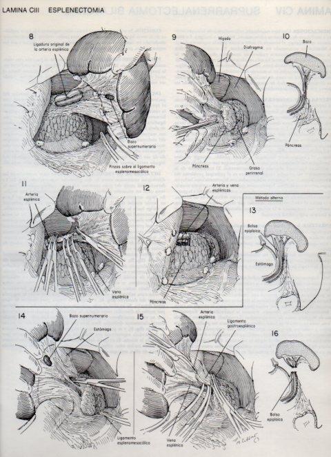 LAMINA V20164: Esplenectomia 1