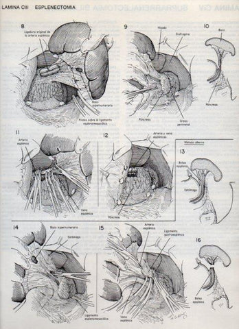 LAMINA V20164: Esplenectomia 1